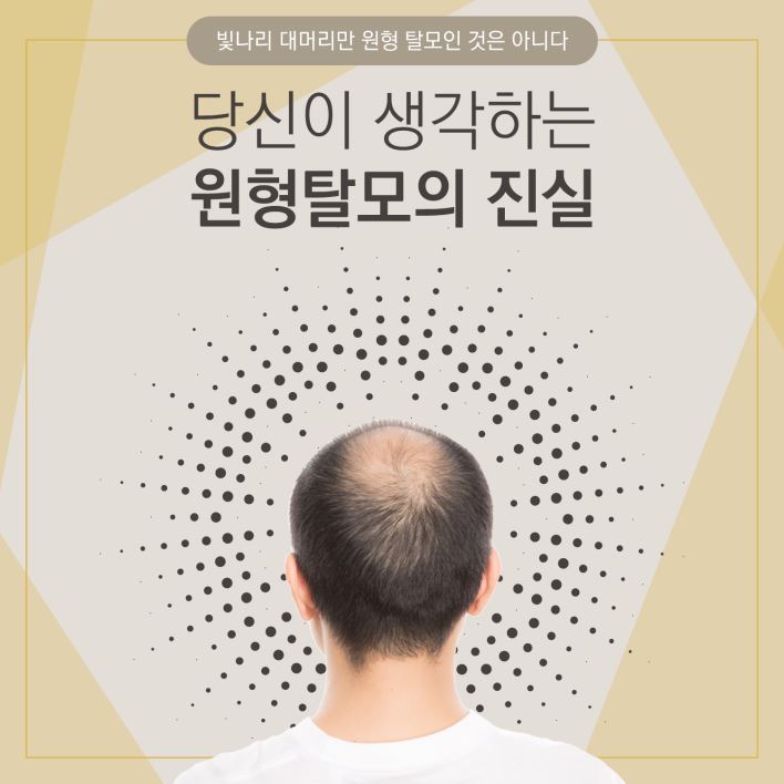 당신이 생각하는 원형탈모의 진실